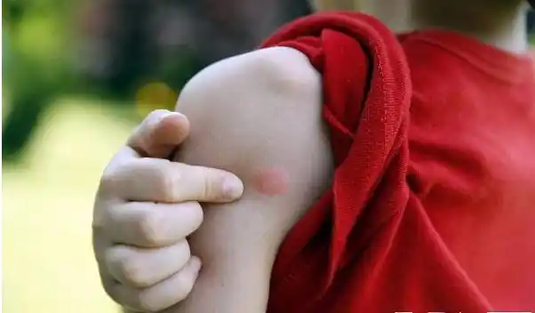 宝宝3岁了被蚊子叮咬后宝妈需要这么做