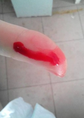 手出血的图片 (42)_有来医生