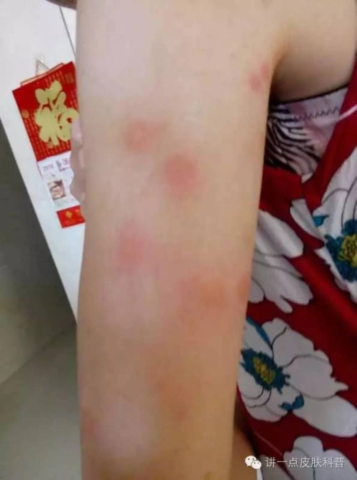 快看,臭虫又重出江湖了