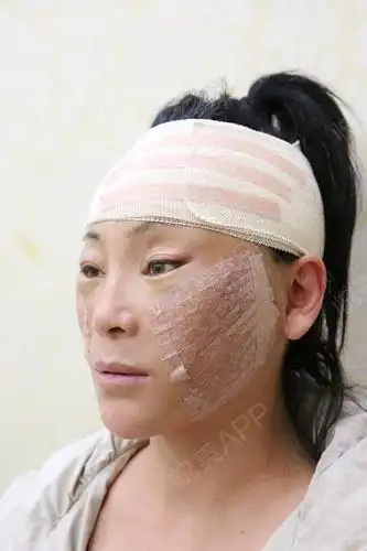 小切口手术提升术后3天_埋线提升术后3天_拉皮手术提升术后3天_紧致