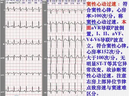本 图avr导联p波倒 置,i,ii,avf, v4-v6导联p波直 立,符合窦性心律
