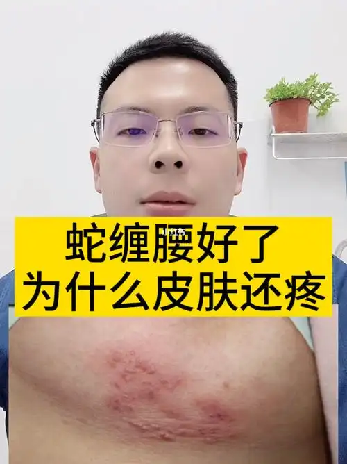 蛇缠腰好了皮肤还会疼