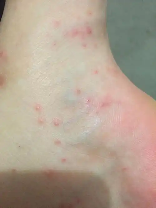 去海里玩之后脚上起了许多红色的小包 很痒 请问是湿疹吗?该怎么办?_