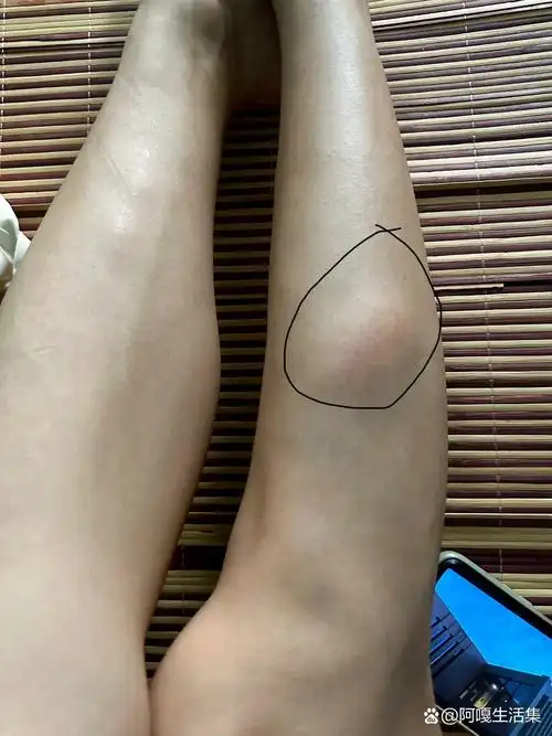 有哪位大神知道小腿突然肿了一块是怎么回事吗?
