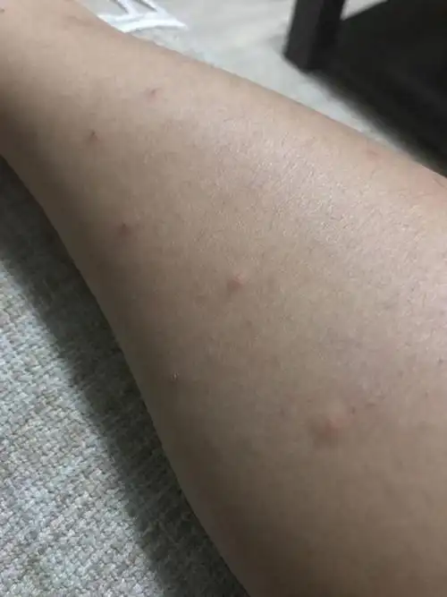 小腿上一晚上长了10个左右红色的疙瘩,特别痒,这是怎么回事