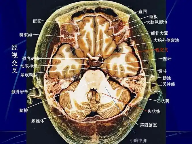 mrippt 颅脑横断层解剖和ct,mri 直回 眶回 嗅束沟 眶板 大脑纵裂池