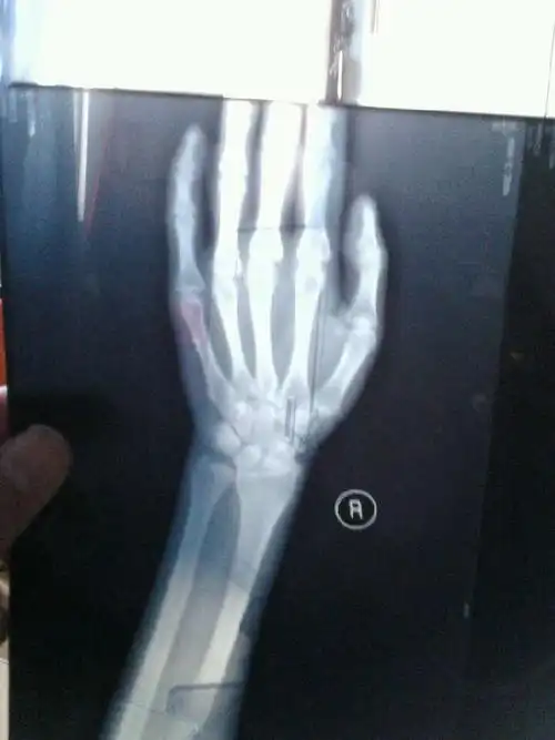 尺骨茎突游离,是这个名字···这是现在的状态.