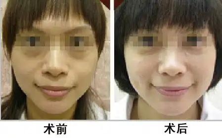 小酒窝大魅力 快来打造你的甜美笑容