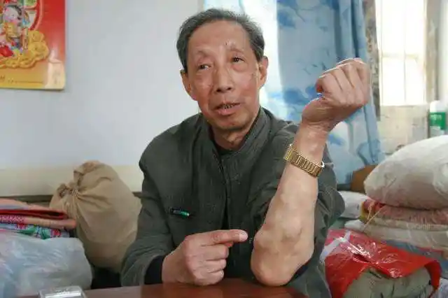 脂肪瘤的危害到底有多大?