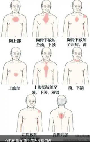 急性心肌梗死患者的健康宣教