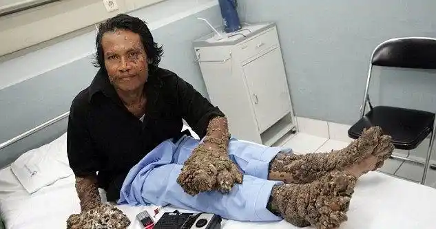 全球五种怪异病魔