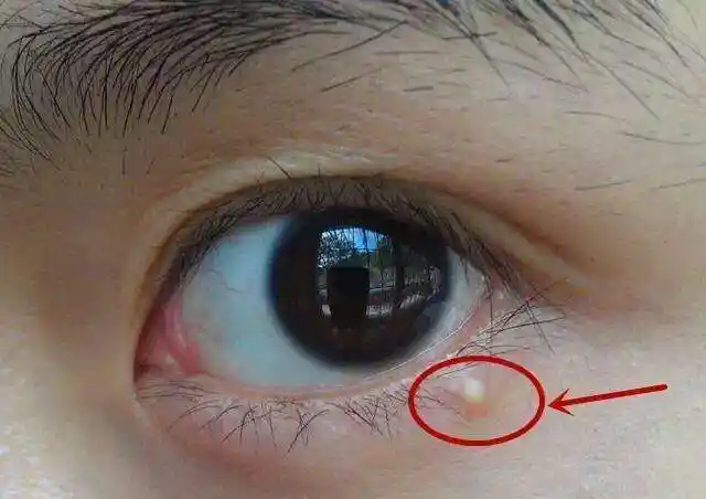 身上长得脂肪瘤有什么危害,如何判断脂肪瘤是良性还是恶性