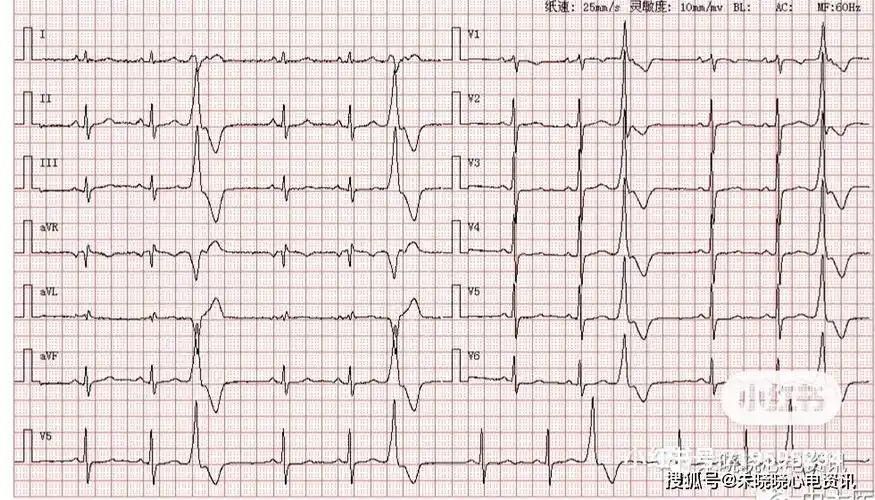 室性早搏(呈三联律)_畸形