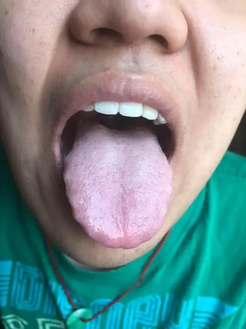 舌苔发白,不爱吃饭是怎么回事呢?