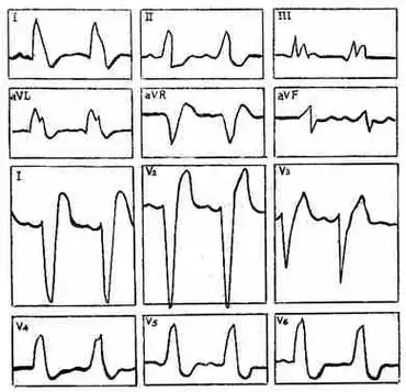 完全性左束支传导阻滞