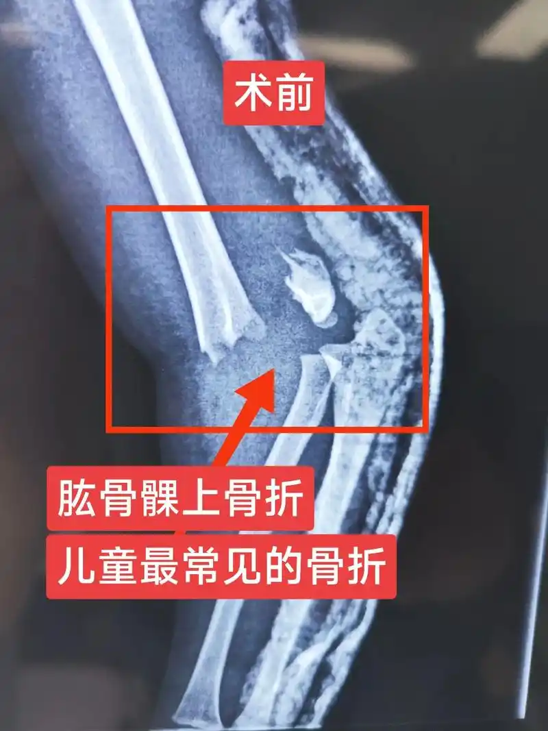 肱骨髁上骨折的手术治疗过程.