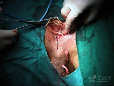 1例伴有腹壁,盆腔及阴囊感染灶的肛门直肠周围脓肿