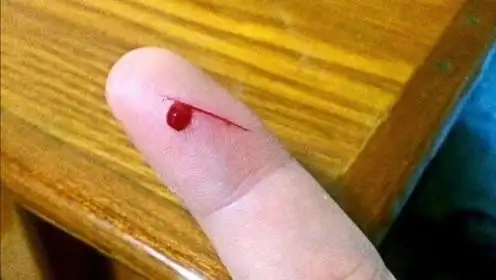 女子手指被纸割伤,以为是小事没放心上,后来却只能截肢保命