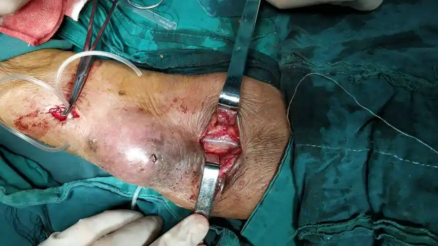 假性动脉瘤的治疗方法