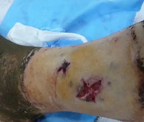 蝮蛇咬一口的伤口有多厉害,看着令人触目惊心!