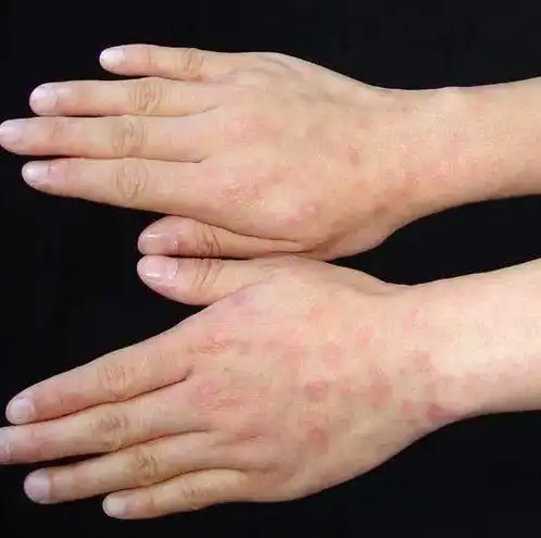 早期梅毒感染症状图图片