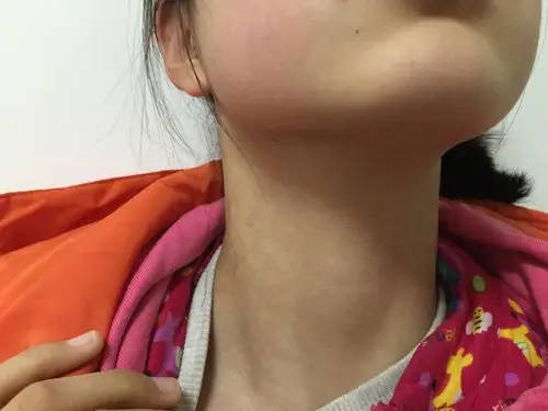 右颈部巨大神经鞘瘤内镜微创无痕切除术后无异常 - 好大夫在线