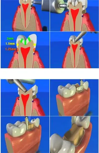 超实用-备牙标准,方法及图解