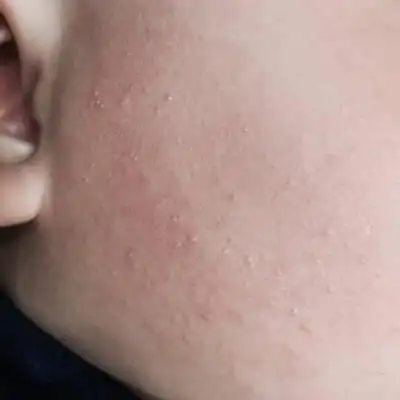 有没有宝妈知道孩子脸上起这样的小疙瘩是什麼