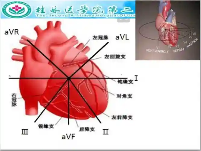 心肌梗死犯罪血管定位诊断陈华说课材料