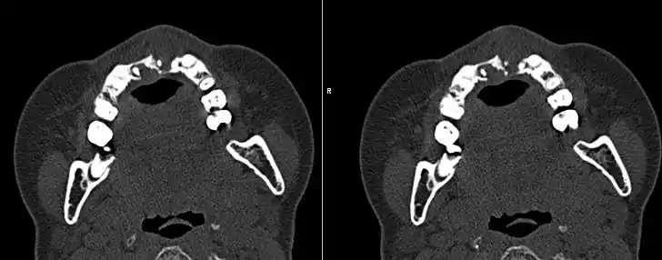ct43534:上颌骨病变