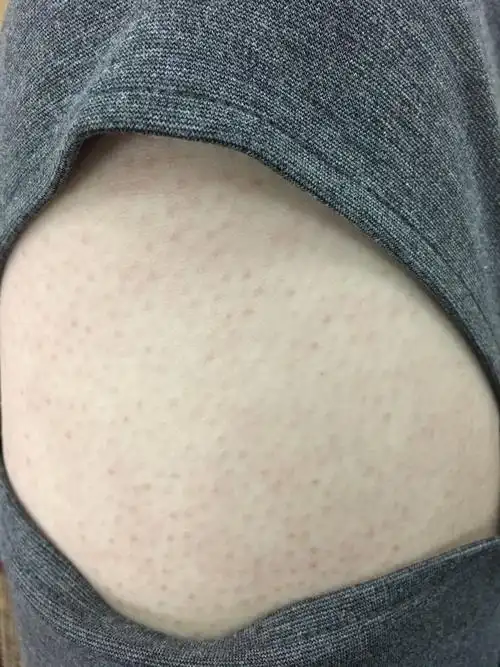 大腿的皮肤怎么才可以消除鸡皮疙瘩_百度知道