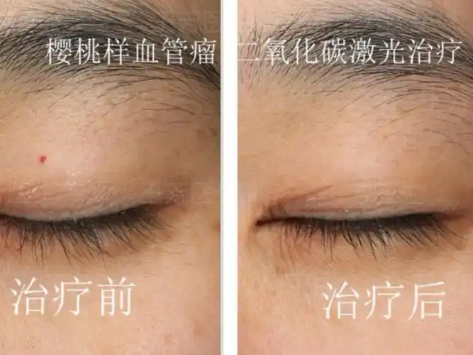 樱桃样血管瘤二氧化碳激光治疗对比案例