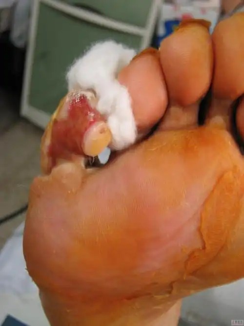 10月22日这是患者入院一个月以后的情况,有新的肉芽长出