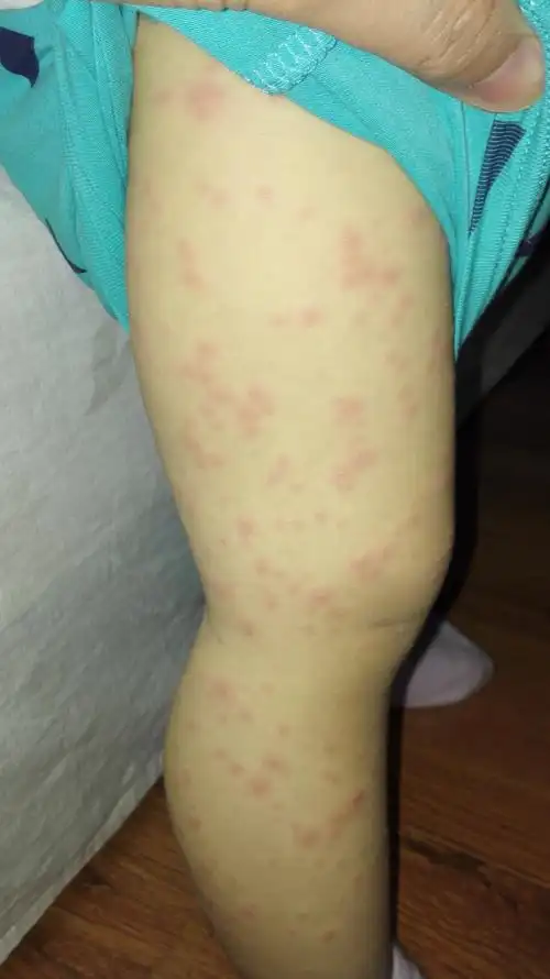 发烧退热后全身出疹子求助这是什么疹