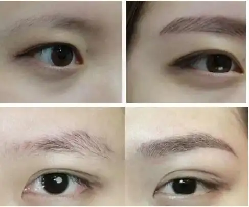 绣眉前后对比案例