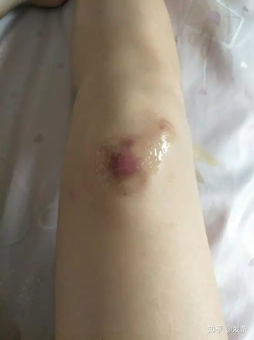 骑车侧翻膝盖摔伤破皮,怎么处理伤口,怎样才能不留疤? - 知乎