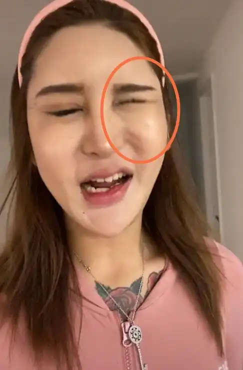 百万网红整容失败,额头有坑嘴肿成"嘟嘟唇",又想做招风耳手术