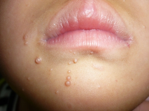 儿童软疣图片 (20)_有来医生