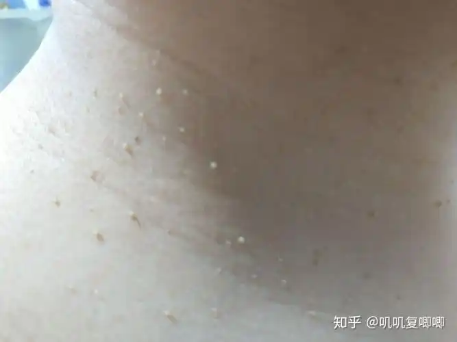 丝状疣,脖子上,女性,医生说要激光扫,有别的办法吗?