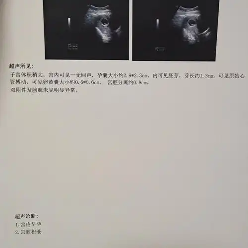 53天看到胎心胎芽了