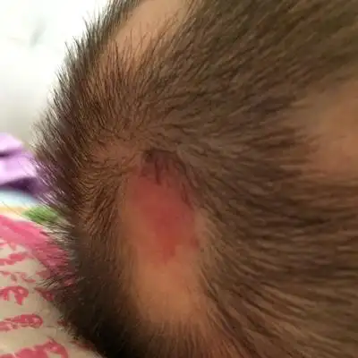 宝宝头上突然就长了一个大红疙瘩,害怕是血管瘤有没有懂的看一看.