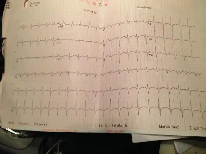 医生说此图是电轴左偏,求诊断
