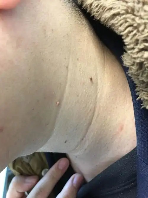 脸上脖子上很多丝状疣来就诊我建议患者美容激光治疗第一个快第二个不