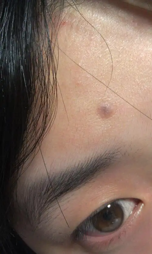 额头上有个痘痘留下的黑色吧.