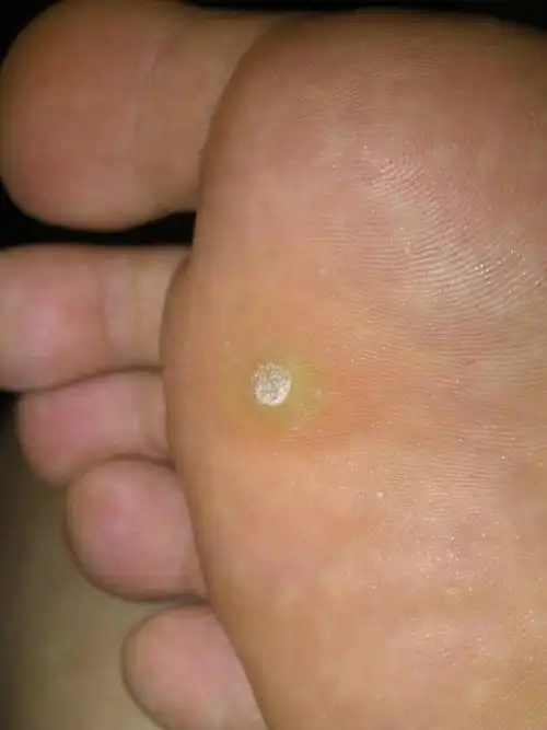 脚底板长了个东西不疼不痒.谁知道是什么,要怎么冶?