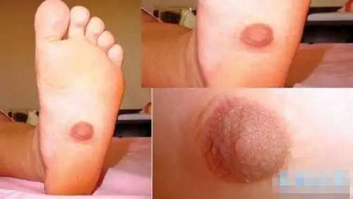 美国21岁女子整形装第三个乳房 世界上拥有三个乳房的女人