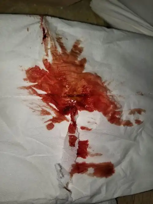 鲜红色血 鲜红色血暗红色-图片大观-奇异网