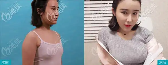 这四张不同尺寸的内窥镜双平面丰胸效果图能看出重庆星宸医院是有实力