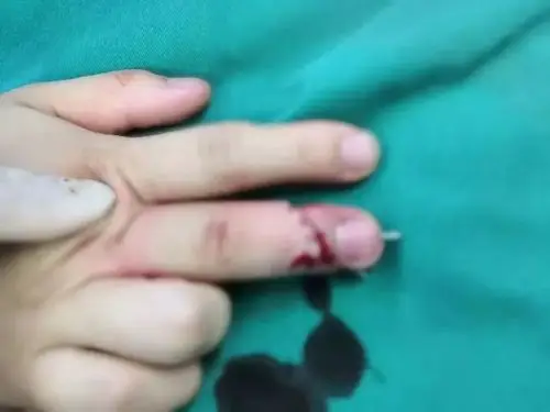 省中医院溧阳分院手足外科"断指再植"术让患者的手指失而复得!