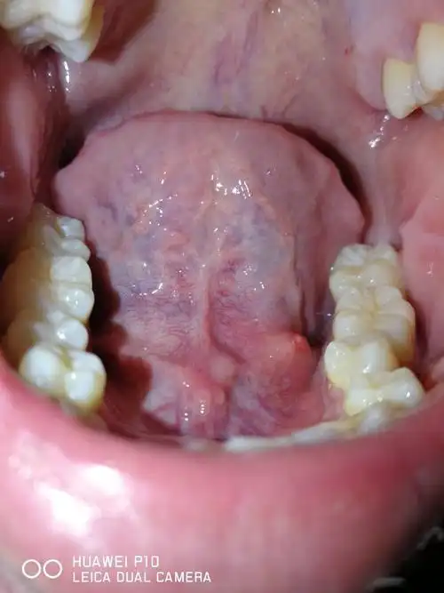 舌头下面长了一个像是水泡又不是水泡的肉芽一样的东西.